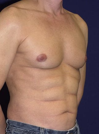 Male Liposuction Before & After Gallery - Patient 9710099 - Image 4