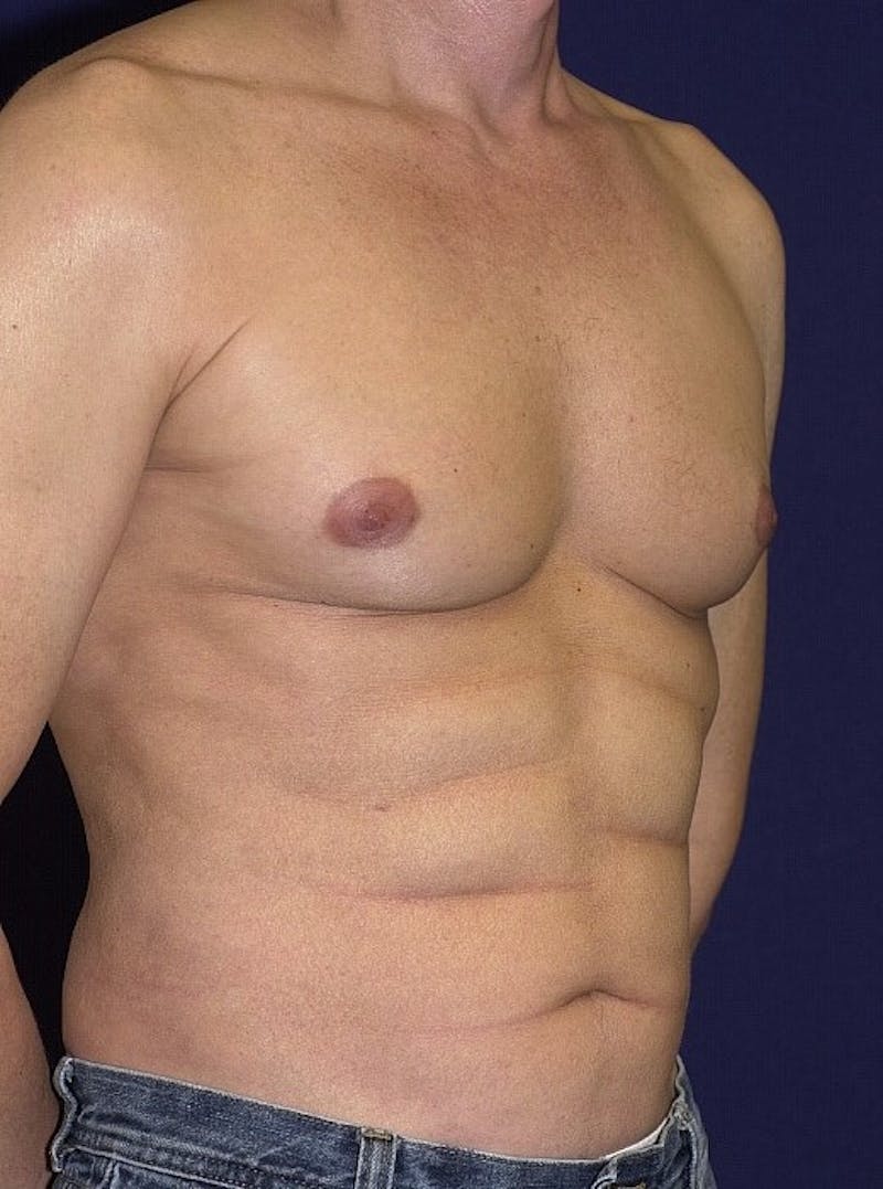 Male Liposuction Before & After Gallery - Patient 9710099 - Image 4