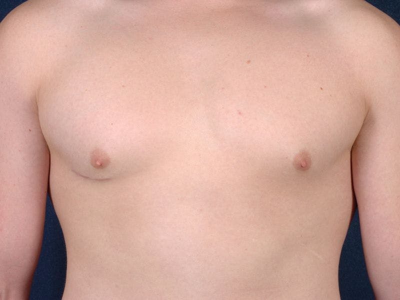 Pectoral Augmentation Before & After Gallery - Patient 9710103 - Image 2