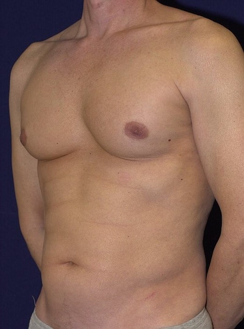 Male Liposuction Before & After Gallery - Patient 9710099 - Image 5
