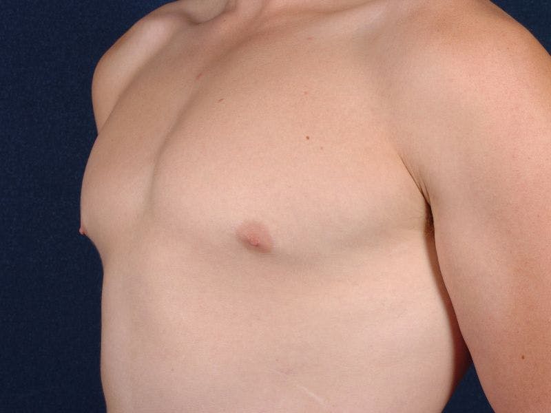 Pectoral Augmentation Before & After Gallery - Patient 9710103 - Image 3