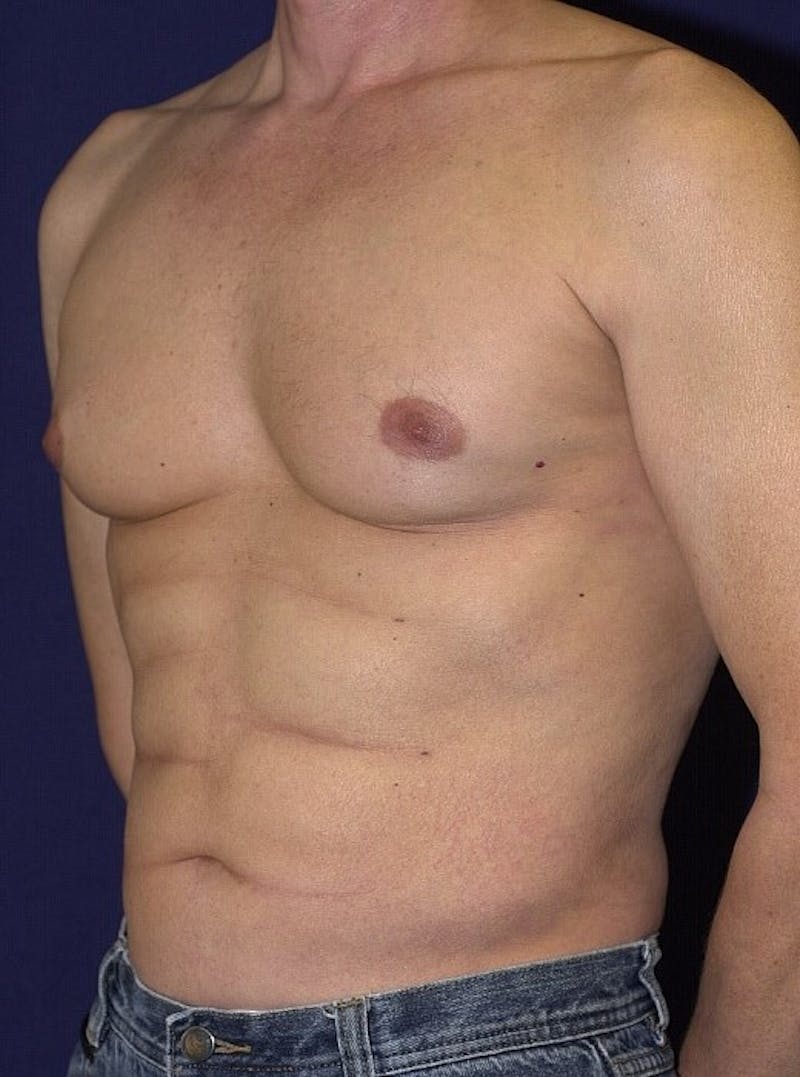 Male Liposuction Before & After Gallery - Patient 9710099 - Image 6