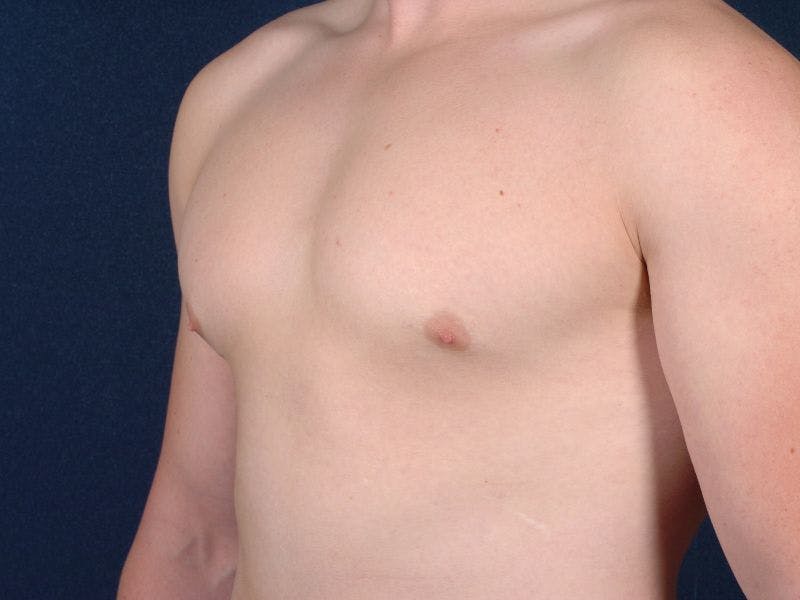 Pectoral Augmentation Before & After Gallery - Patient 9710103 - Image 4
