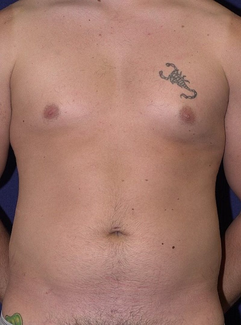 Male Liposuction Before & After Gallery - Patient 9710108 - Image 1