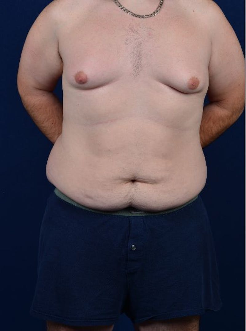 Massive Weight-Loss Body Contouring Before & After Gallery - Patient 9710107 - Image 1