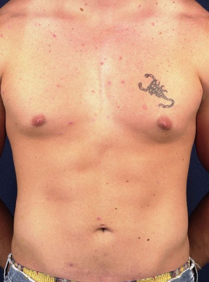 Male Liposuction Before & After Gallery - Patient 9710108 - Image 2