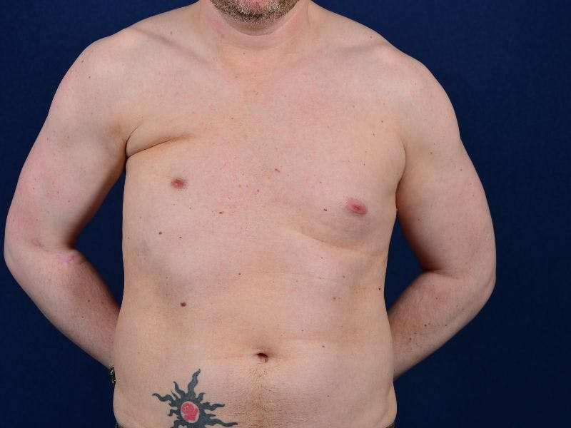 Pectoral Augmentation Before & After Gallery - Patient 9710109 - Image 1