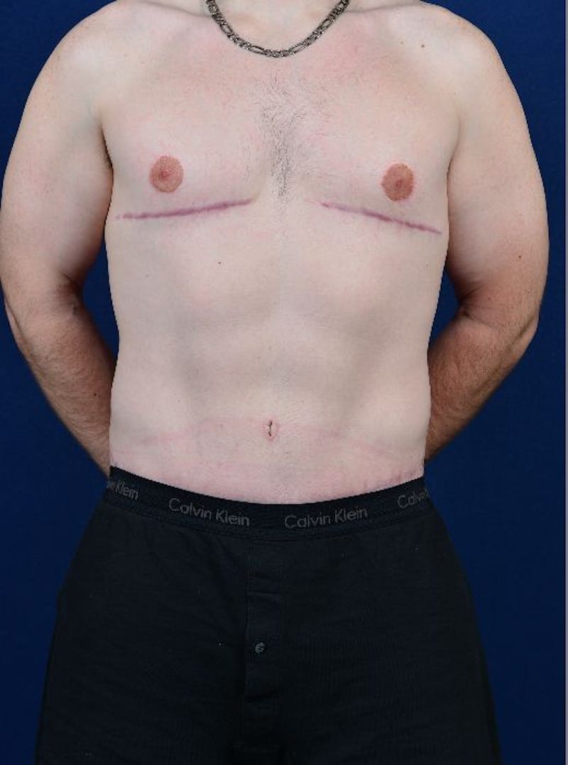 Massive Weight-Loss Body Contouring Before & After Gallery - Patient 9710107 - Image 2