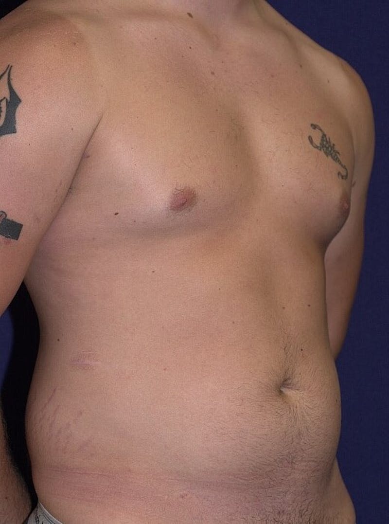 Male Liposuction Before & After Gallery - Patient 9710108 - Image 3
