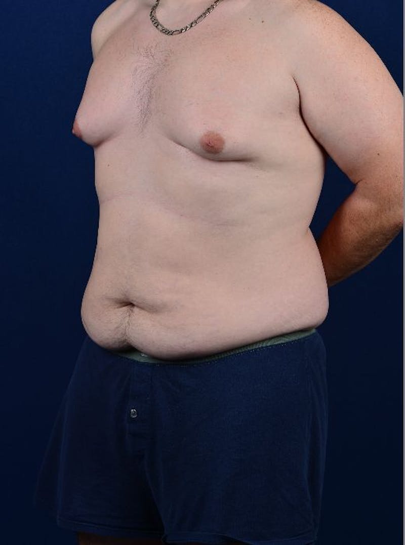 Massive Weight-Loss Body Contouring Before & After Gallery - Patient 9710107 - Image 3