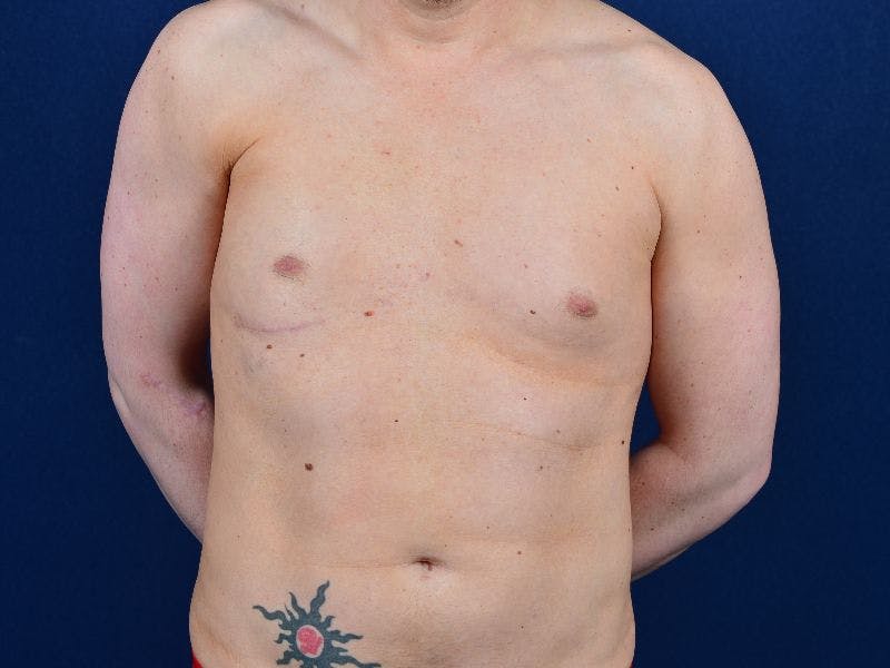 Pectoral Augmentation Before & After Gallery - Patient 9710109 - Image 2