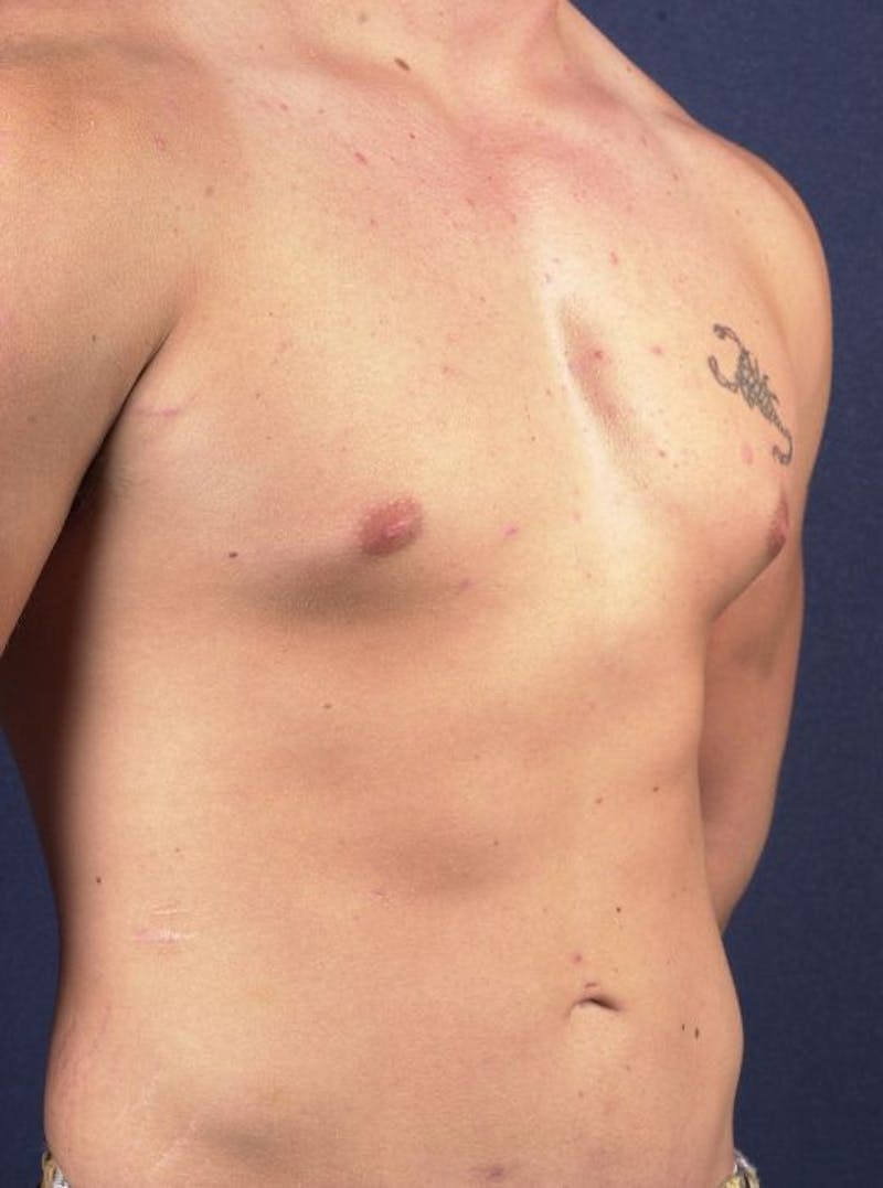 Male Liposuction Gallery - Patient 9710108 - Image 4