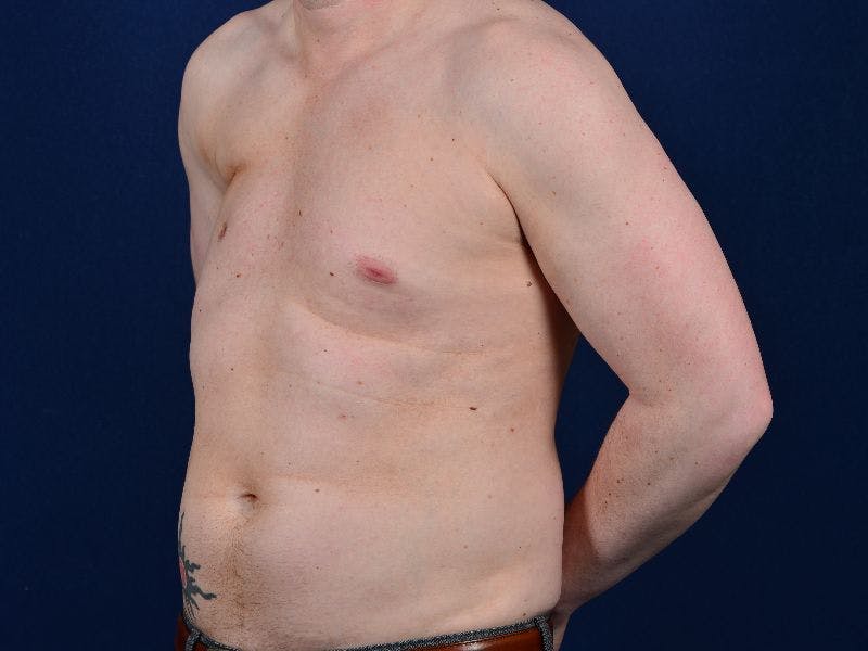 Pectoral Augmentation Before & After Gallery - Patient 9710109 - Image 3