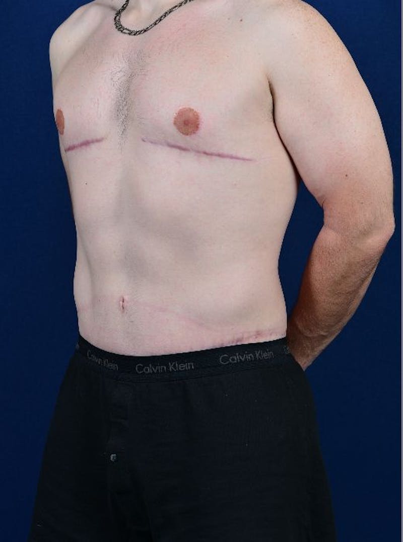 Massive Weight-Loss Body Contouring Before & After Gallery - Patient 9710107 - Image 4
