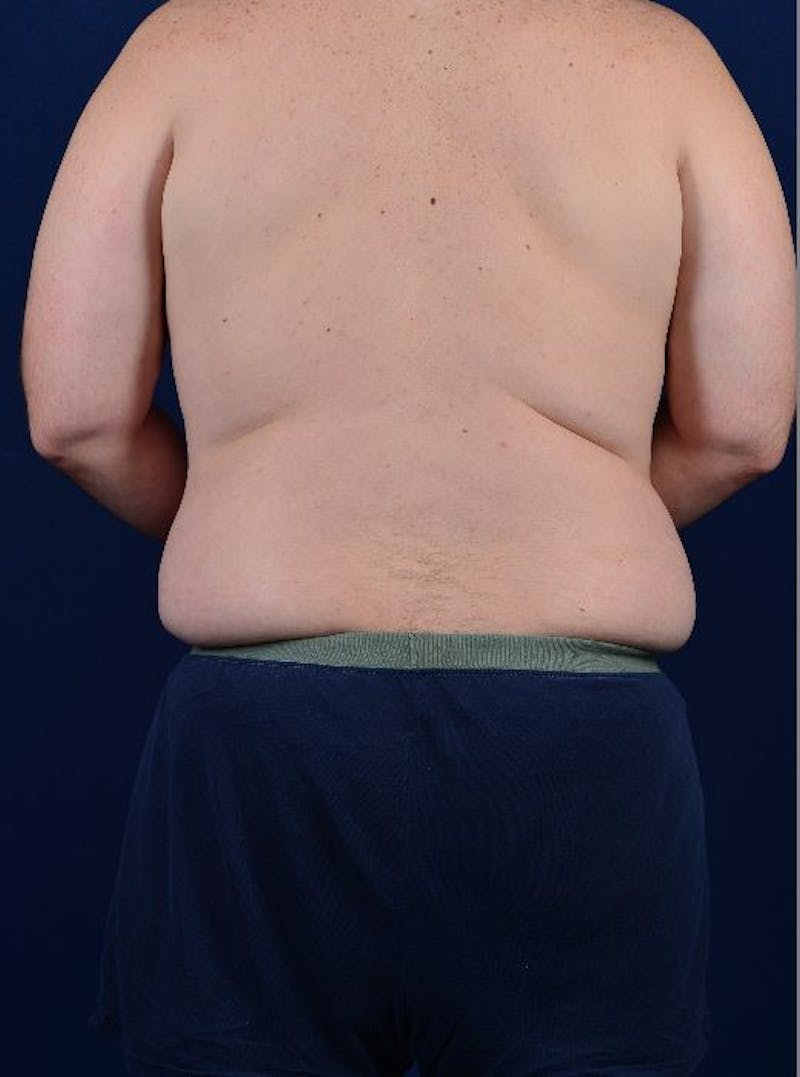 Massive Weight-Loss Body Contouring Before & After Gallery - Patient 9710107 - Image 5