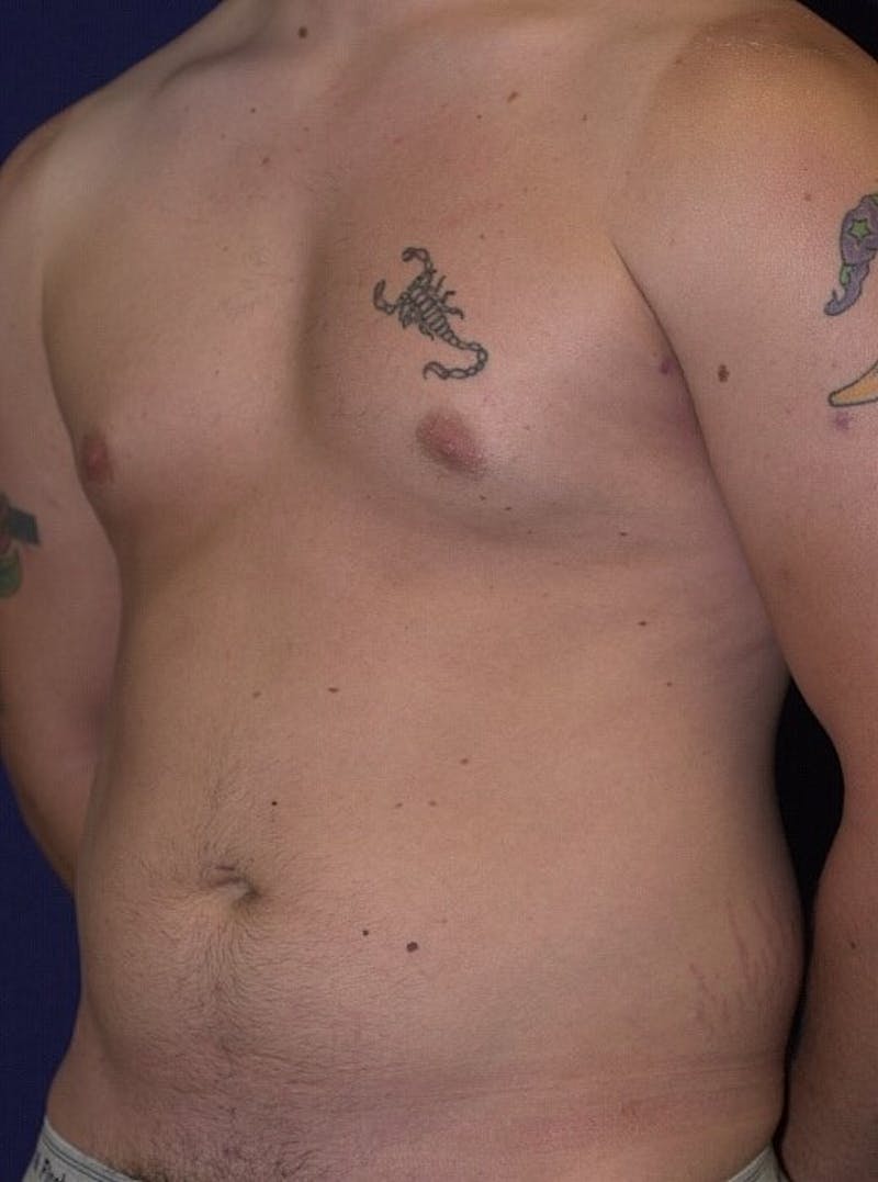Male Liposuction Before & After Gallery - Patient 9710108 - Image 5