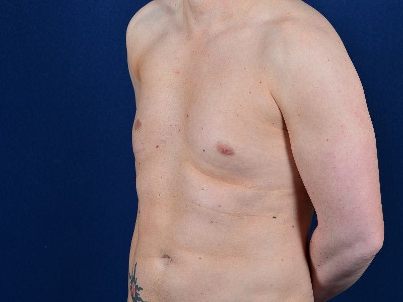Pectoral Augmentation Before & After Gallery - Patient 9710109 - Image 4