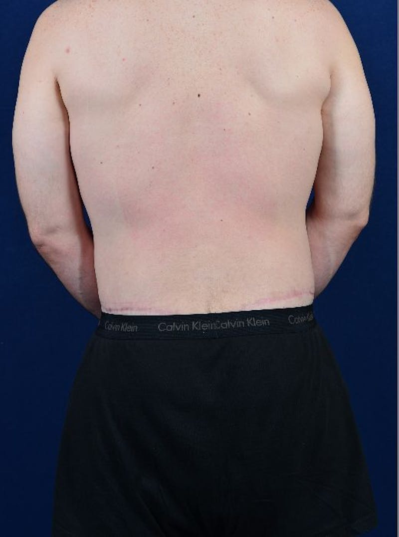Massive Weight-Loss Body Contouring Before & After Gallery - Patient 9710107 - Image 6