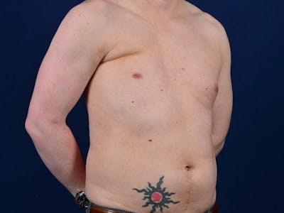Pectoral Augmentation Before & After Gallery - Patient 9710109 - Image 5