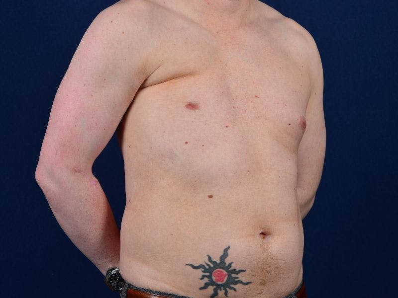 Pectoral Augmentation Before & After Gallery - Patient 9710109 - Image 5