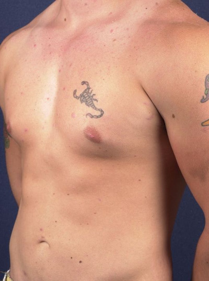 Male Liposuction Gallery - Patient 9710108 - Image 6