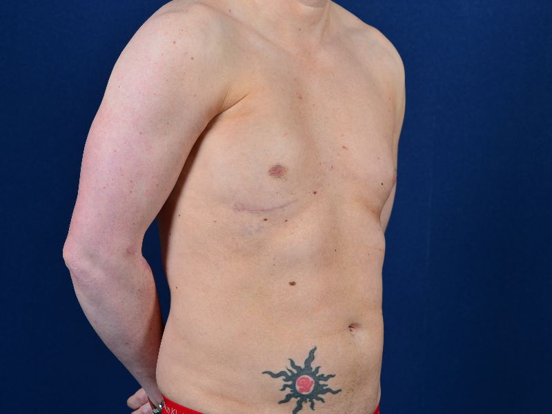 Pectodil Injection Pectoral Augmentation Before & After Photos | Egrari