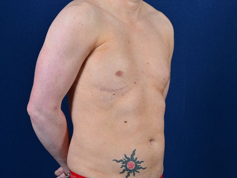 Pectoral Augmentation Before & After Gallery - Patient 9710109 - Image 6