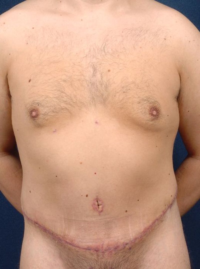 Massive Weight-Loss Body Contouring Gallery - Patient 9710110 - Image 2