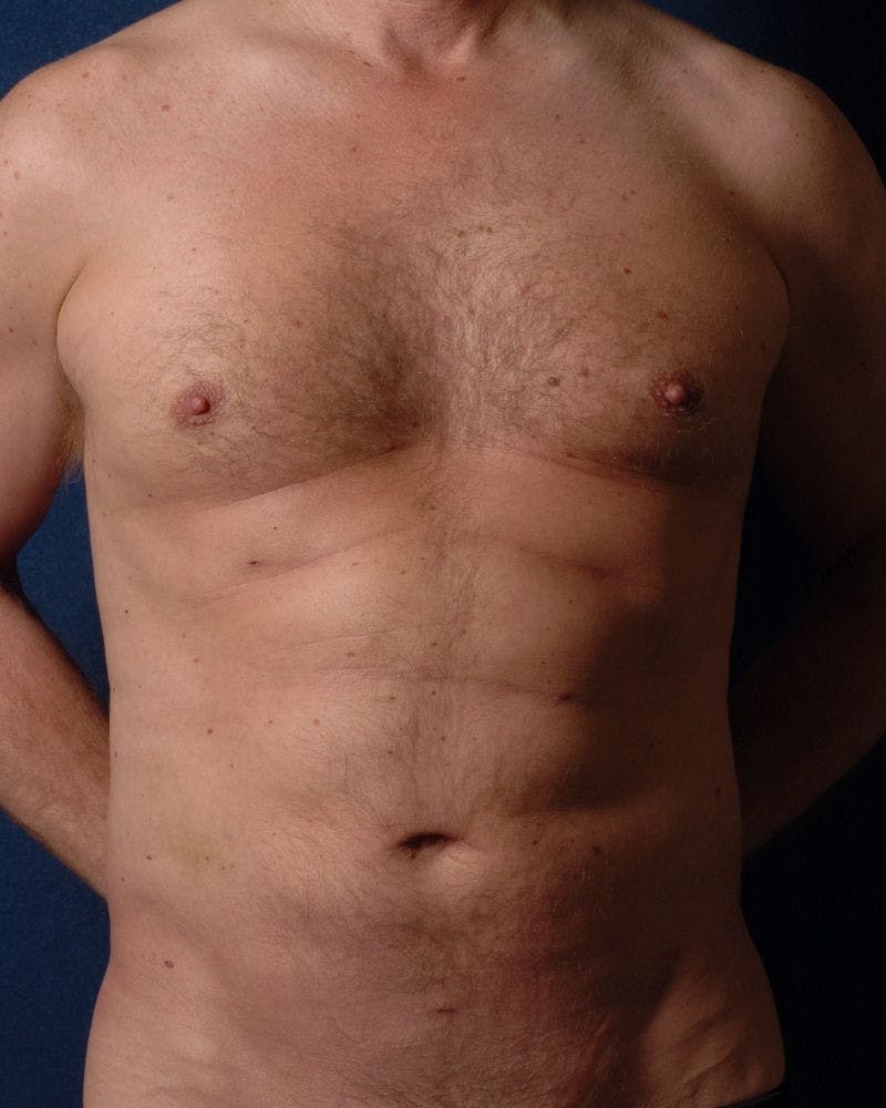 Male Liposuction Before & After Gallery - Patient 9710115 - Image 2