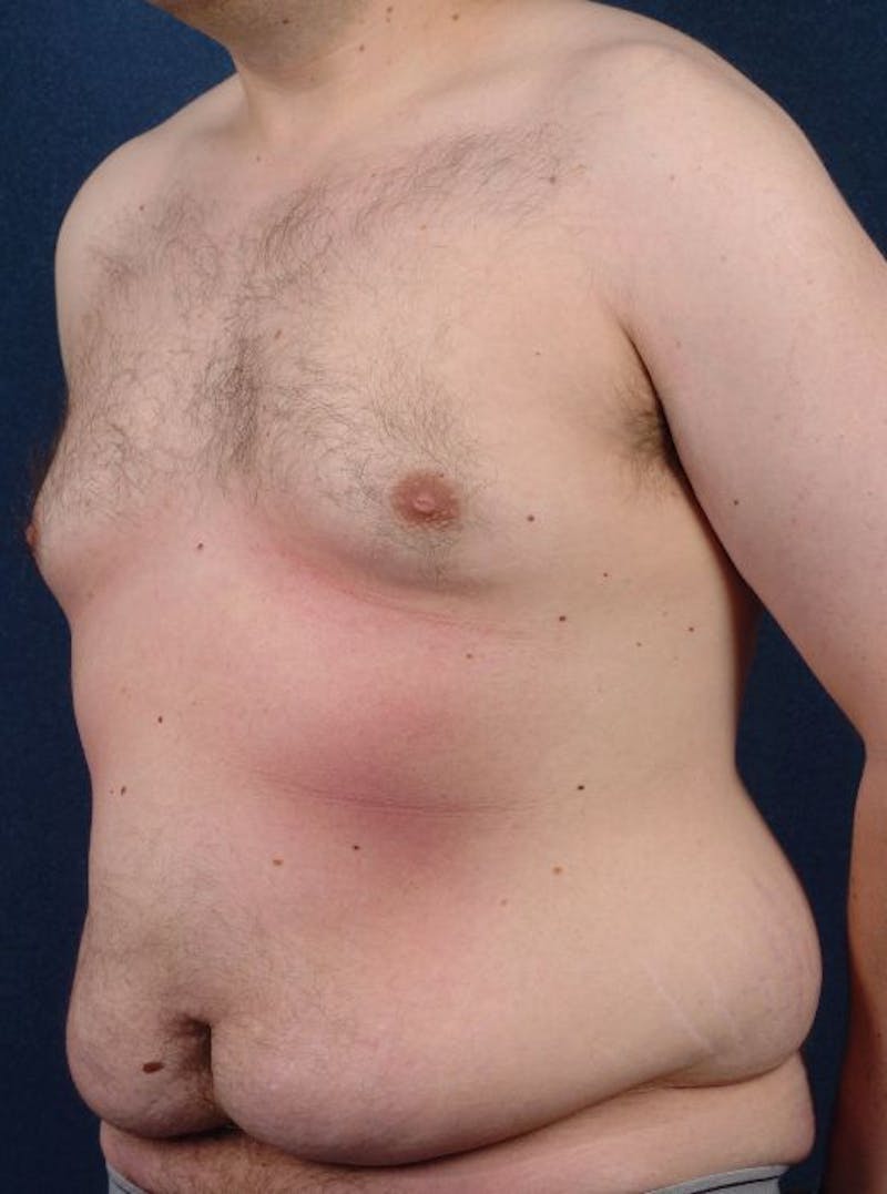 Massive Weight-Loss Body Contouring Before & After Gallery - Patient 9710110 - Image 3