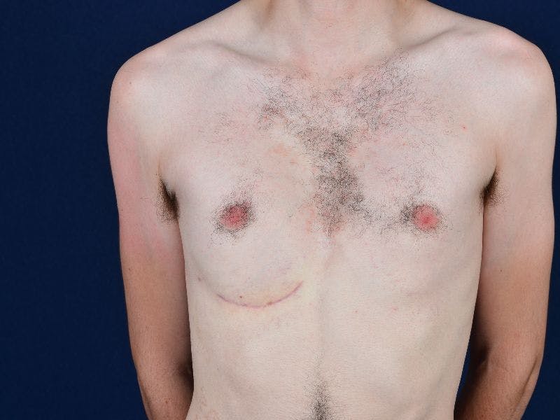 Pectoral Augmentation Before & After Gallery - Patient 9710111 - Image 2