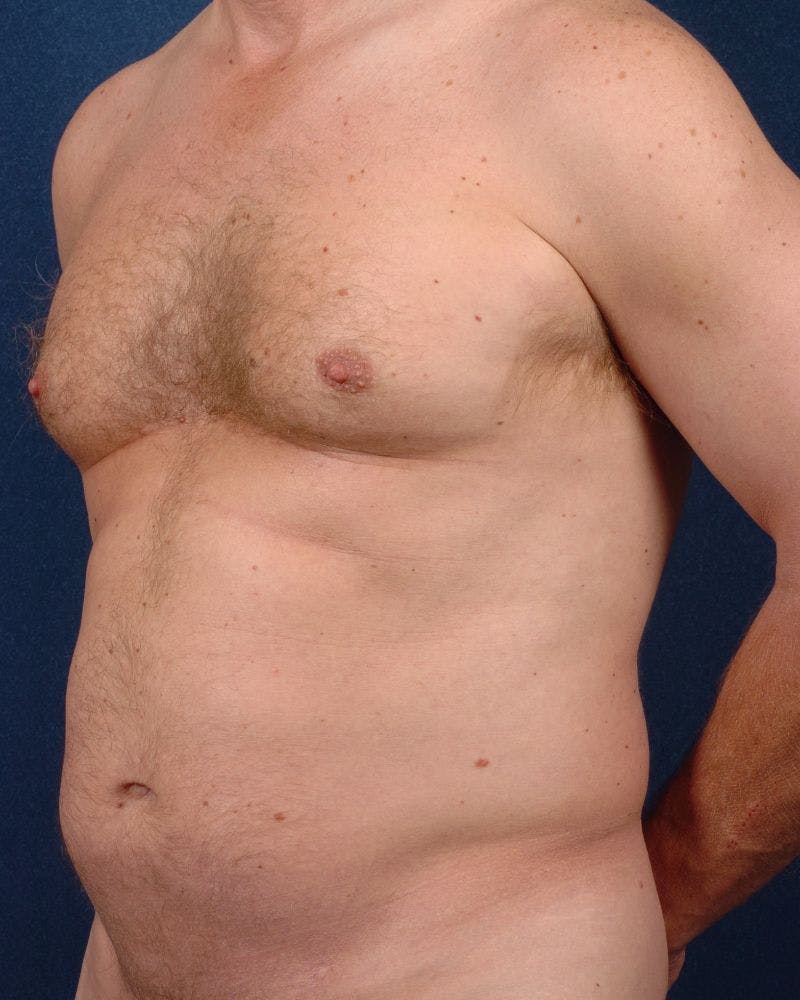 Male Liposuction Before & After Gallery - Patient 9710115 - Image 3