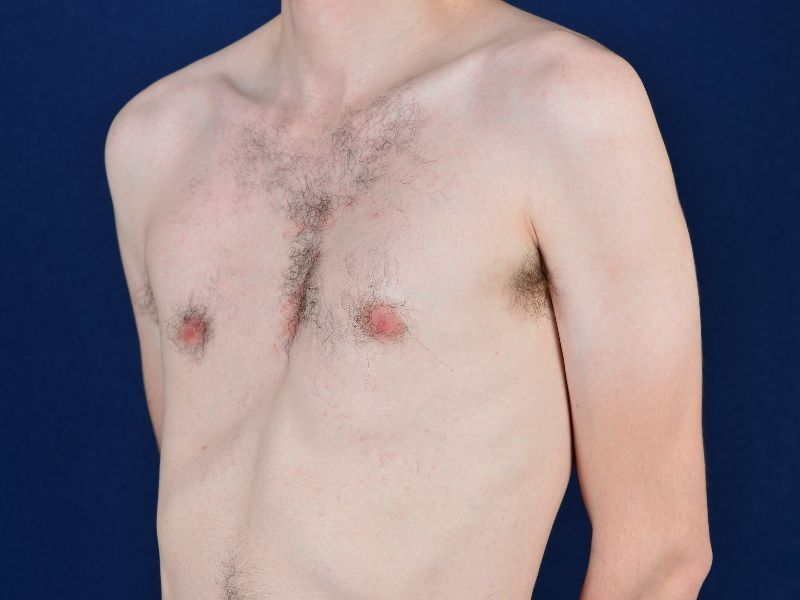 Pectodil Injection Pectoral Augmentation Before & After Photos | Egrari