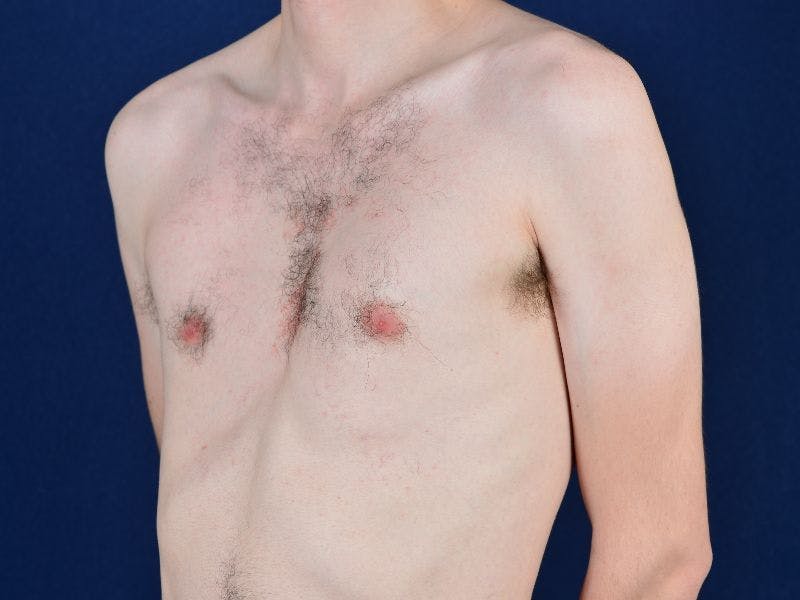 Pectoral Augmentation Before & After Gallery - Patient 9710111 - Image 3