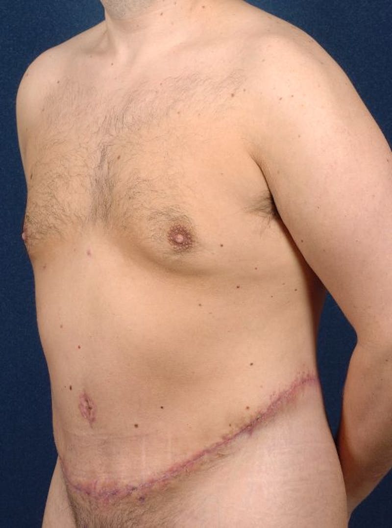 Massive Weight-Loss Body Contouring Gallery - Patient 9710110 - Image 4