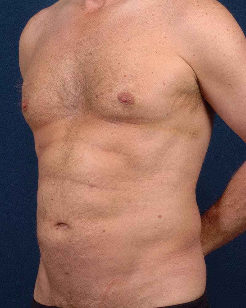 Male Liposuction Before & After Gallery - Patient 9710115 - Image 4