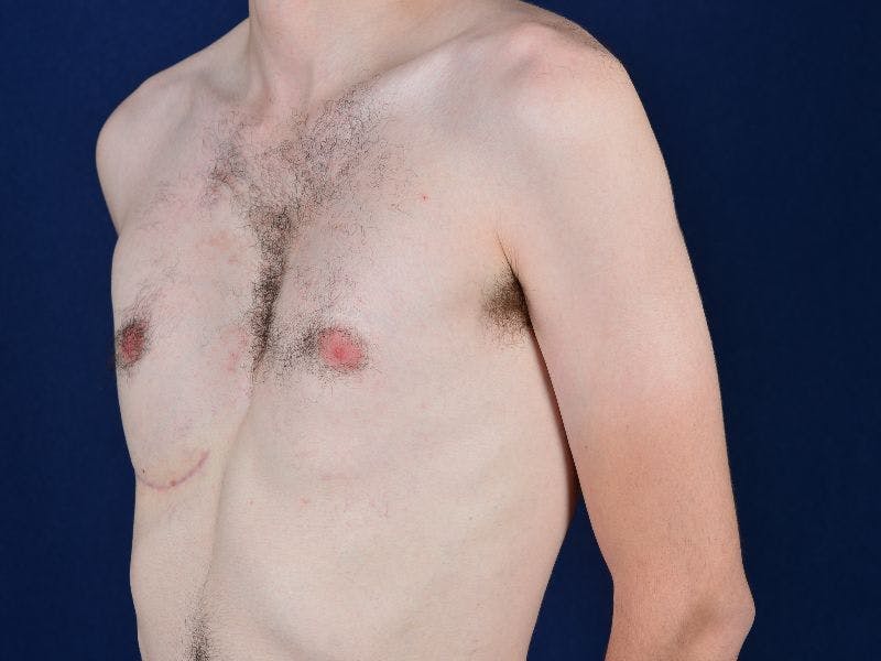 Pectoral Augmentation Before & After Gallery - Patient 9710111 - Image 4
