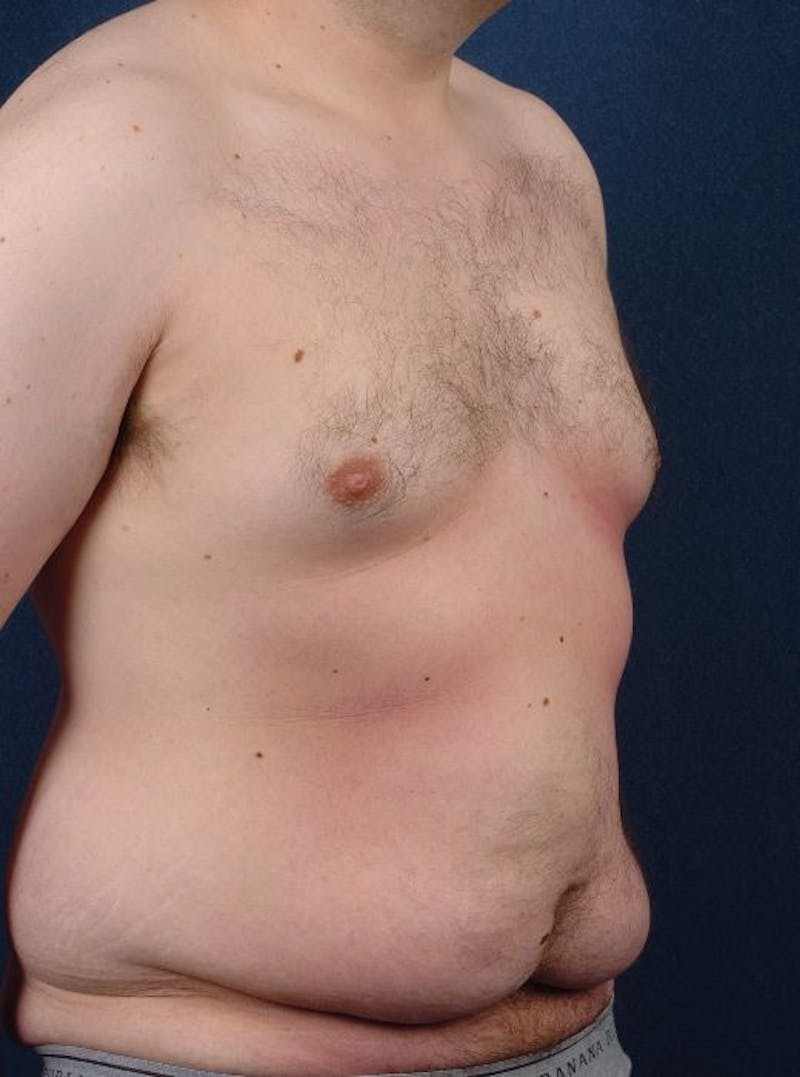 Massive Weight-Loss Body Contouring Before & After Gallery - Patient 9710110 - Image 5