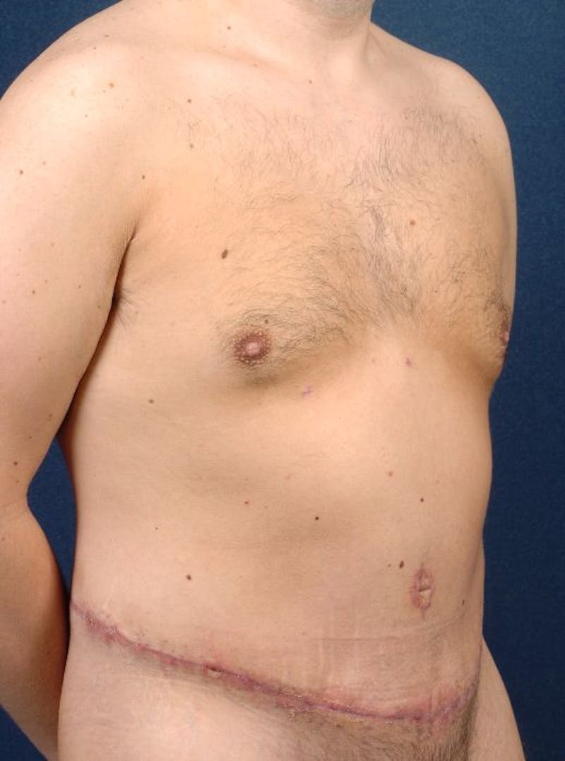 Massive Weight-Loss Body Contouring Before & After Gallery - Patient 9710110 - Image 6