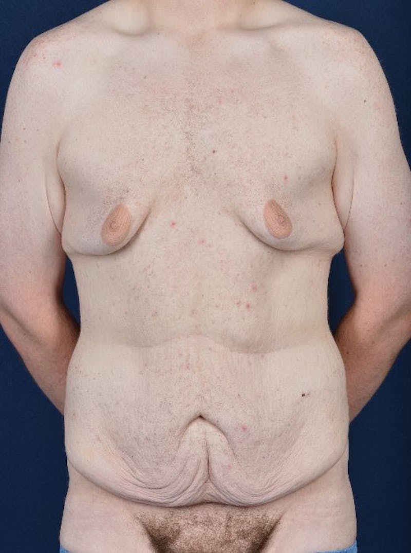 Massive Weight-Loss Body Contouring Before & After Gallery - Patient 9710116 - Image 1