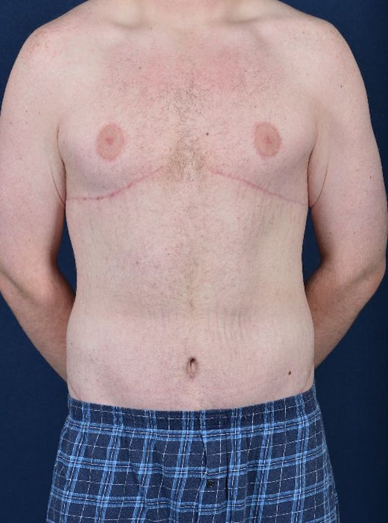 Massive Weight-Loss Body Contouring Before & After Gallery - Patient 9710116 - Image 2