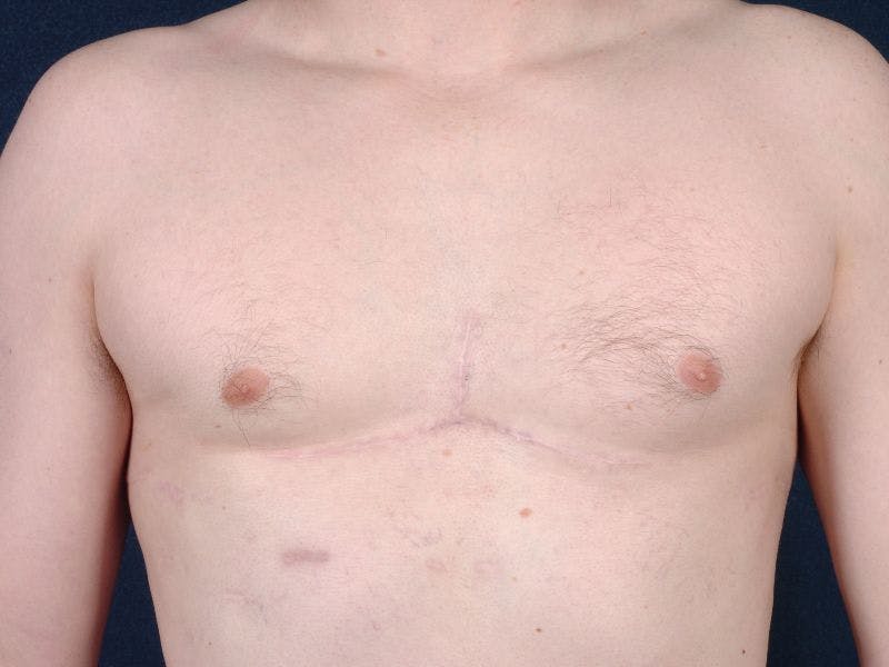 Pectoral Augmentation Before & After Gallery - Patient 9710118 - Image 1