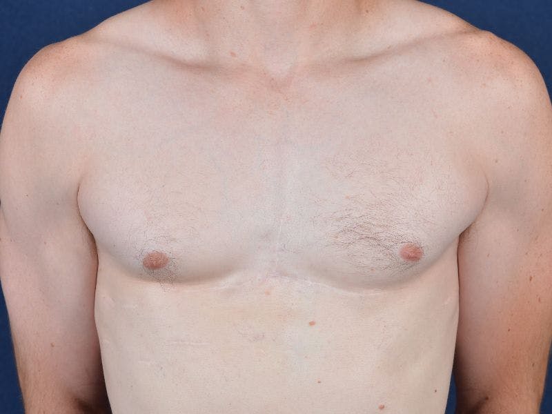 Pectoral Augmentation Before & After Gallery - Patient 9710118 - Image 2