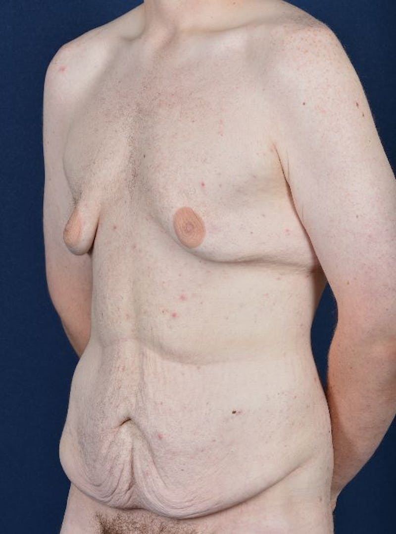 Massive Weight-Loss Body Contouring Gallery - Patient 9710116 - Image 3