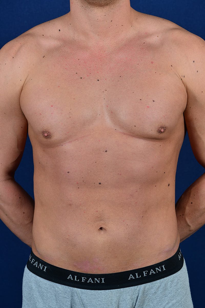 Male Liposuction Before & After Gallery - Patient 9710121 - Image 1