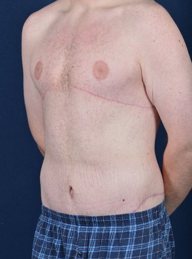 Massive Weight-Loss Body Contouring Before & After Gallery - Patient 9710116 - Image 4