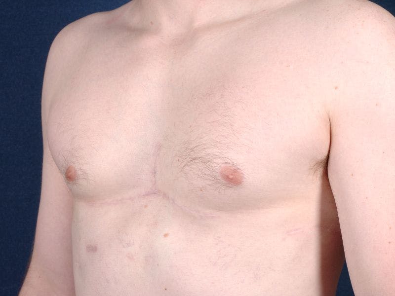 Pectoral Augmentation Before & After Gallery - Patient 9710118 - Image 3
