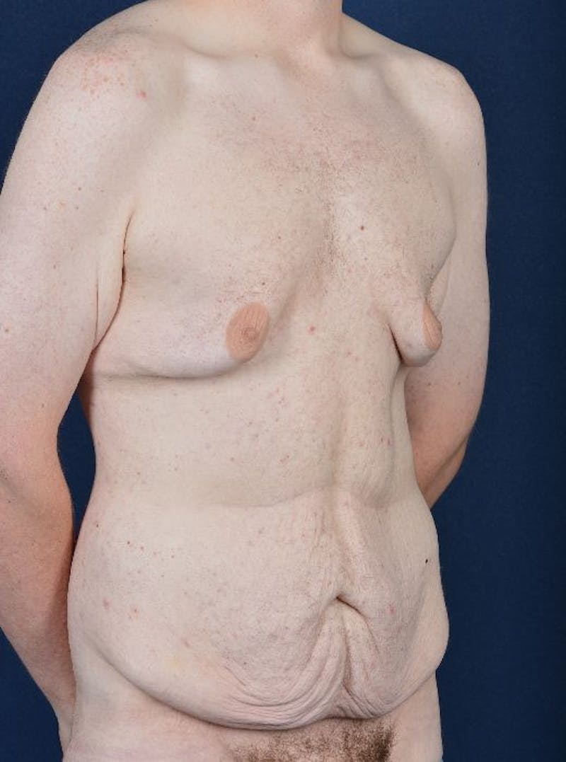 Massive Weight-Loss Body Contouring Before & After Gallery - Patient 9710116 - Image 5