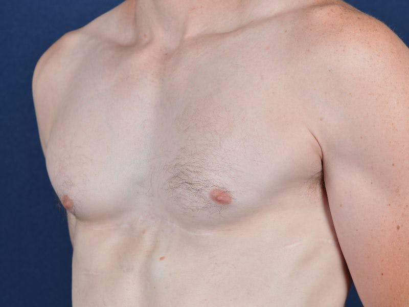 Pectoral Augmentation Before & After Gallery - Patient 9710118 - Image 4