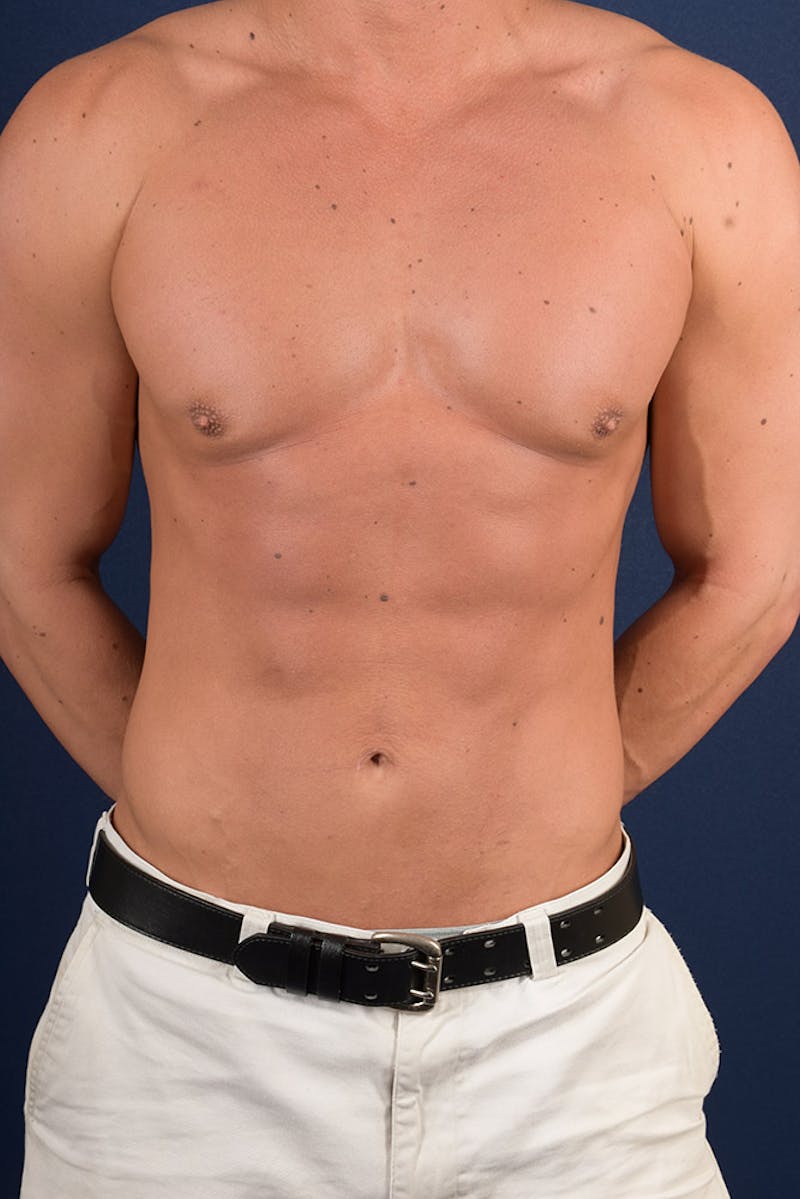 Male Liposuction Before & After Gallery - Patient 9710121 - Image 2